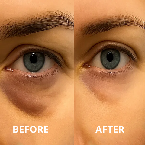 Dark Circles