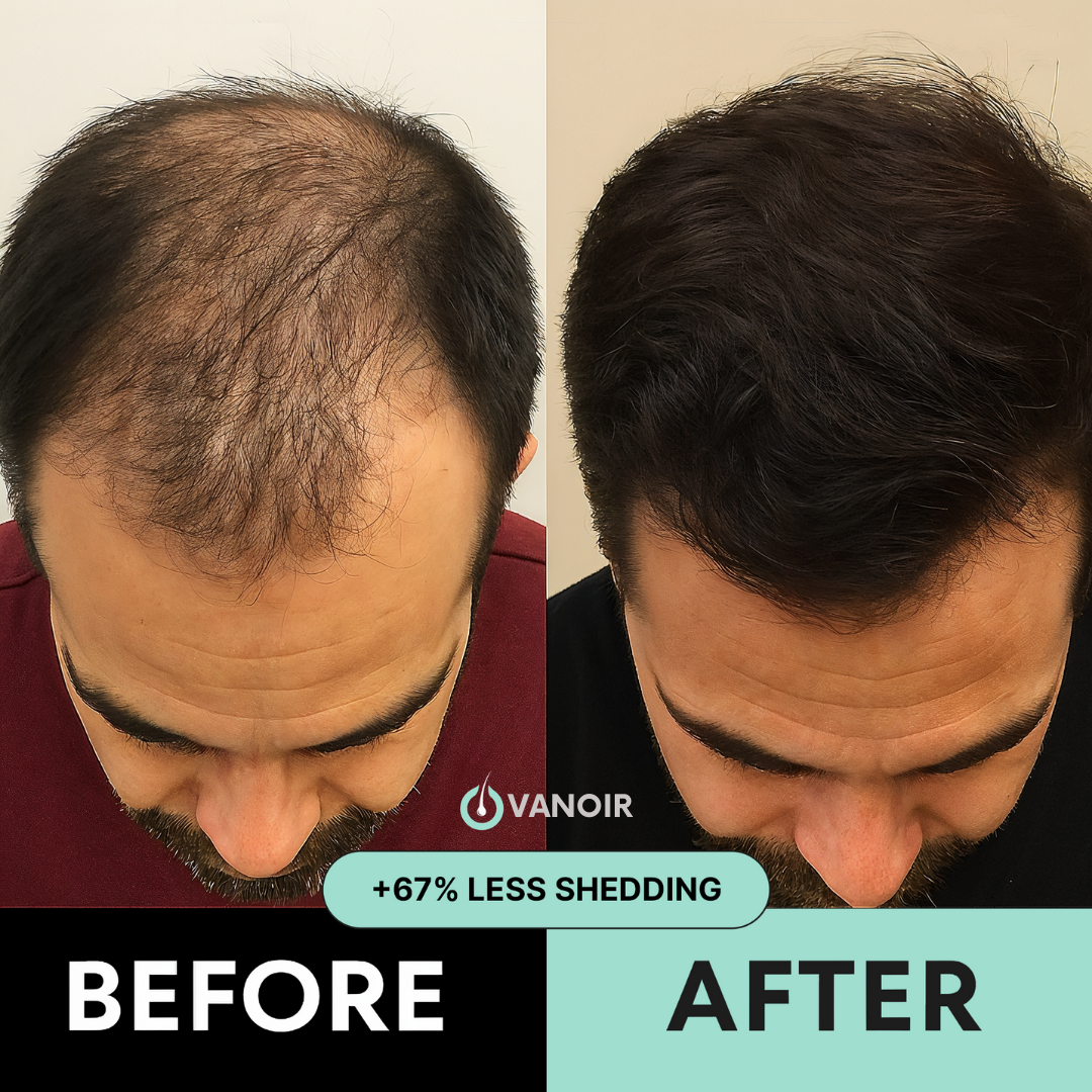 Hair Regrowth Micro-Infusion System (Men)