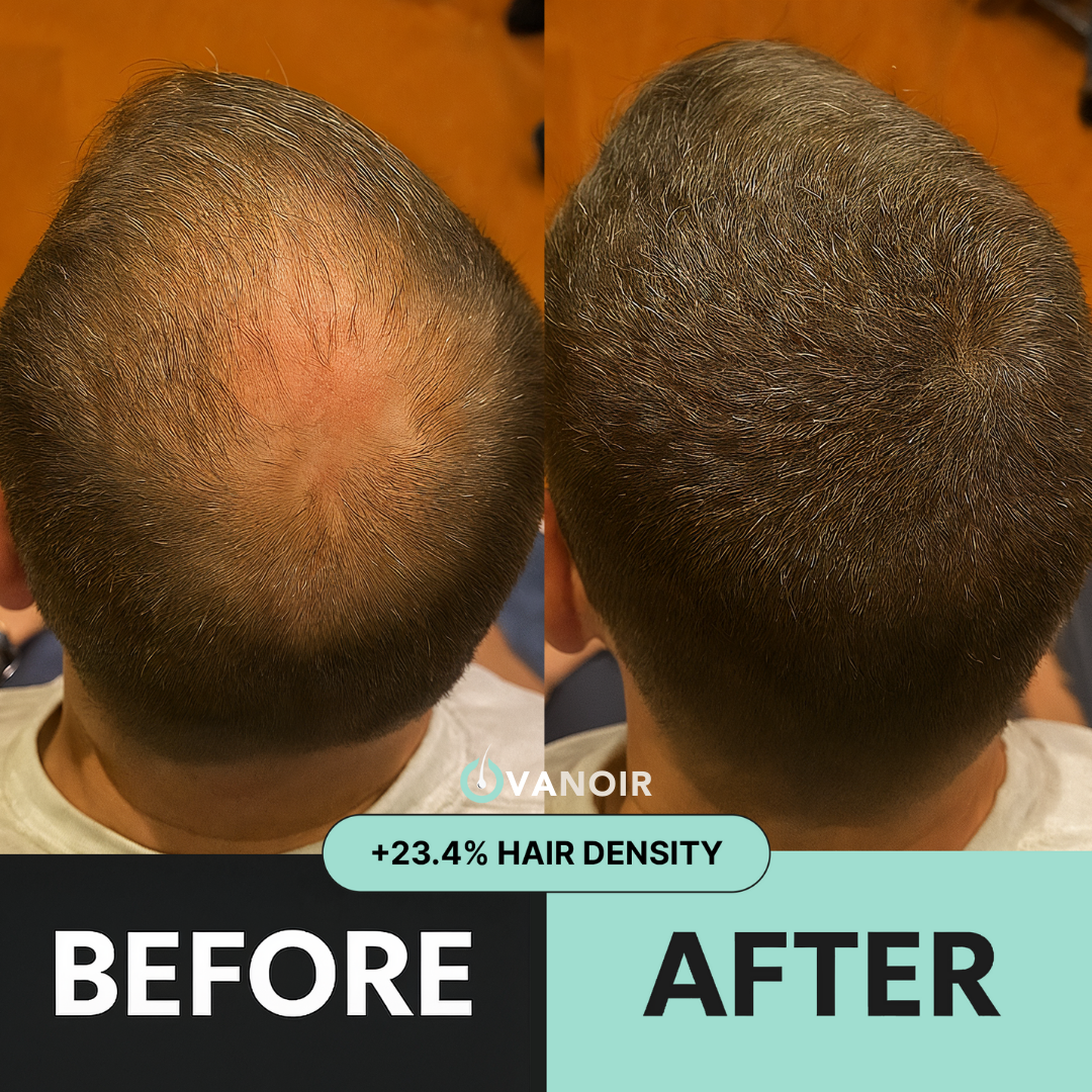 Hair Regrowth Micro-Infusion System (Men)