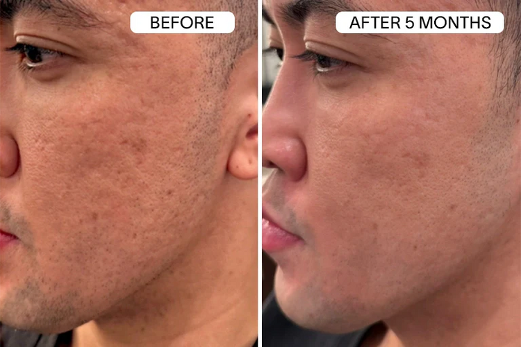 Rolling Scars & Uneven Skin