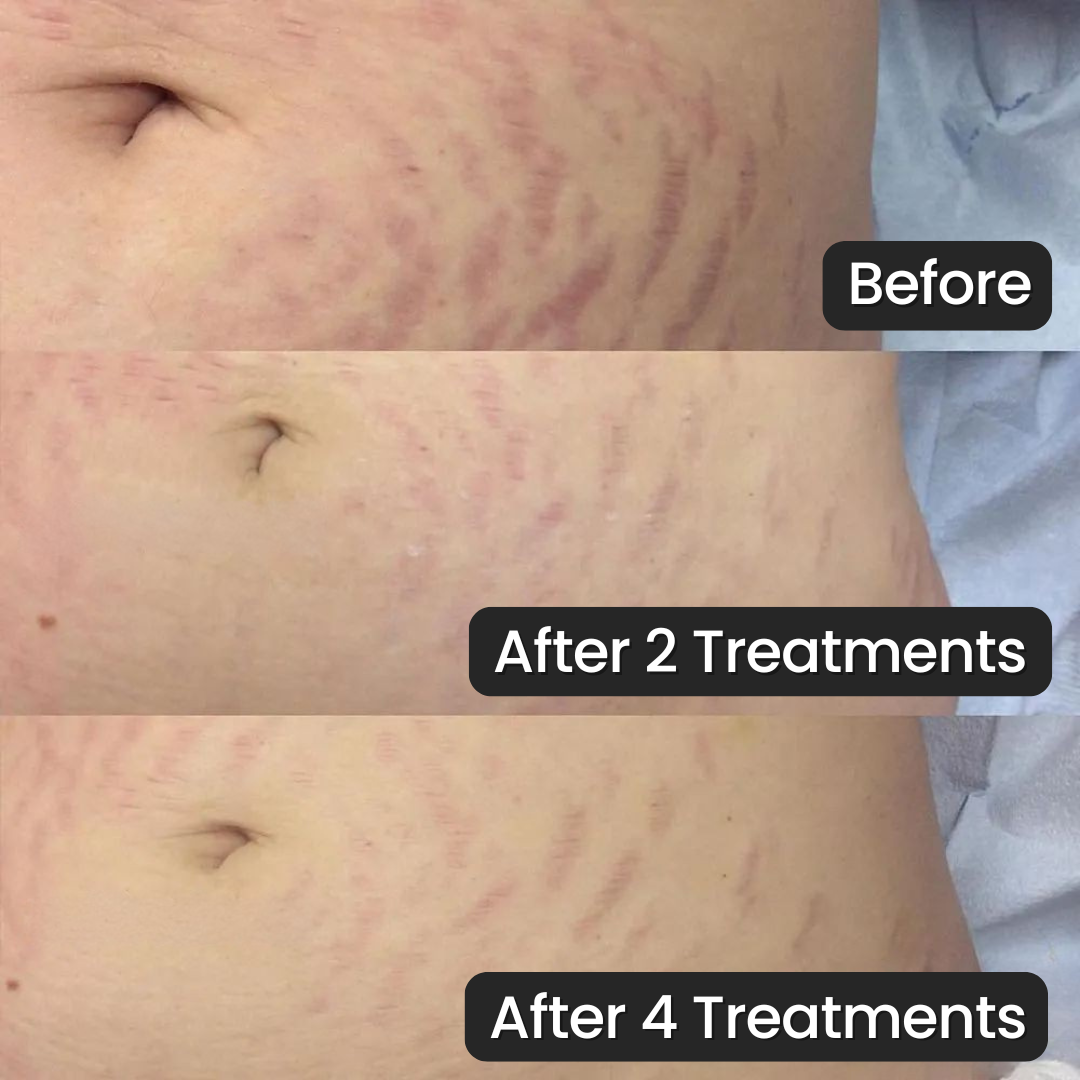 Vanoir Stretch Mark System