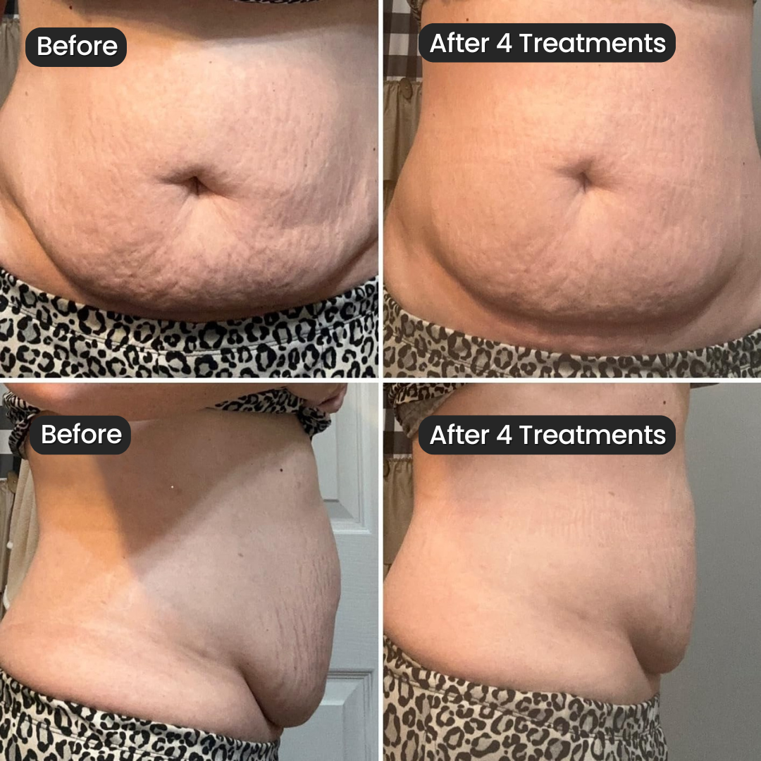 Vanoir Stretch Mark System
