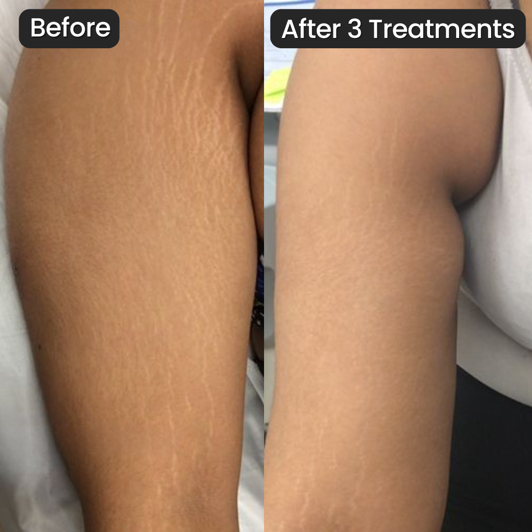 Vanoir Stretch Mark System