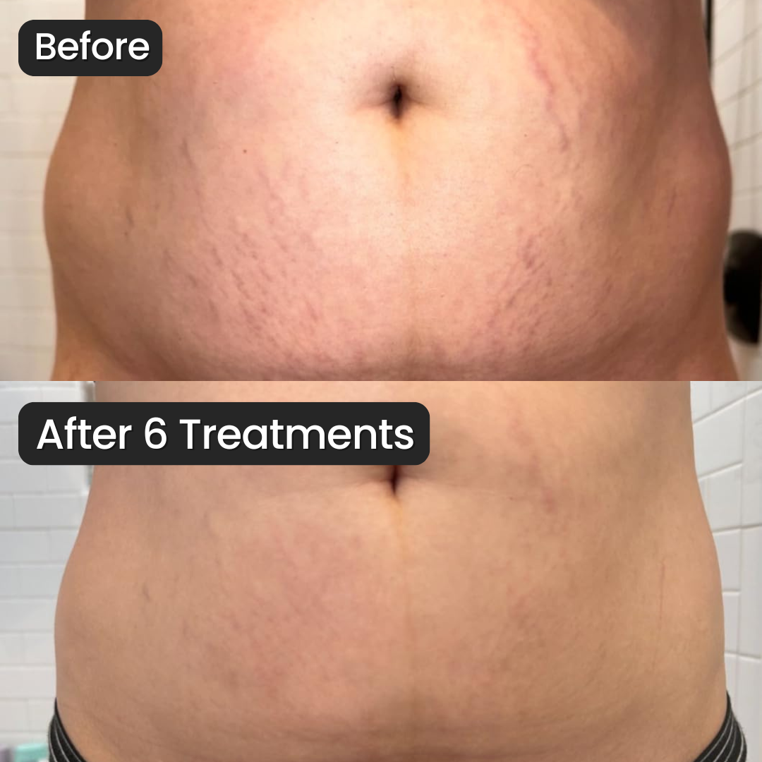 Vanoir Stretch Mark System