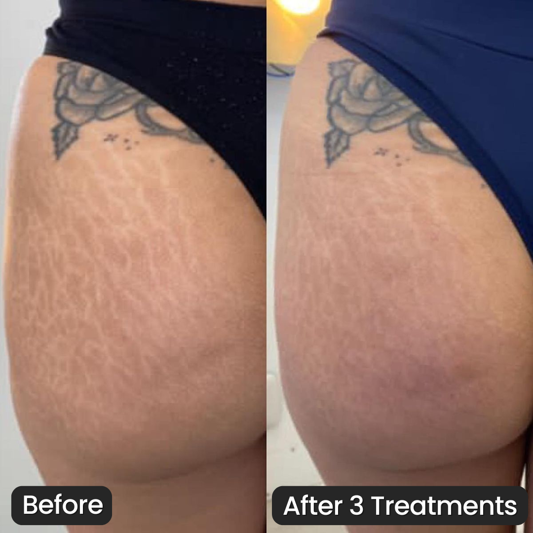 Vanoir Stretch Mark System