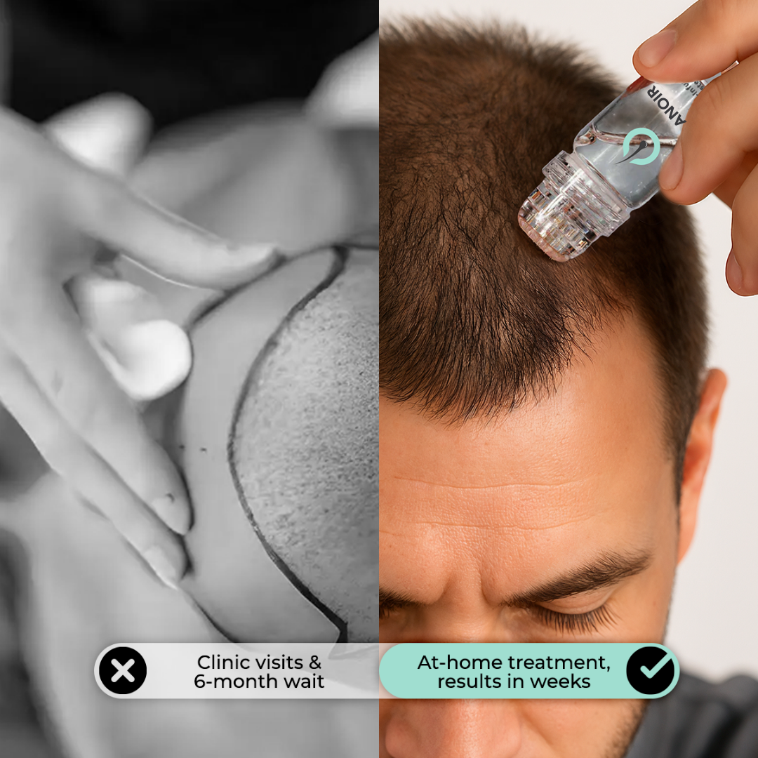 Hair Regrowth Micro-Infusion System (Men)