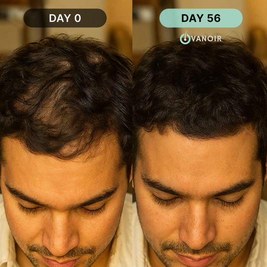 Hair Regrowth Micro-Infusion System (Men)