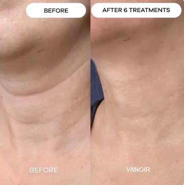 Wrinkly & Saggy Neck